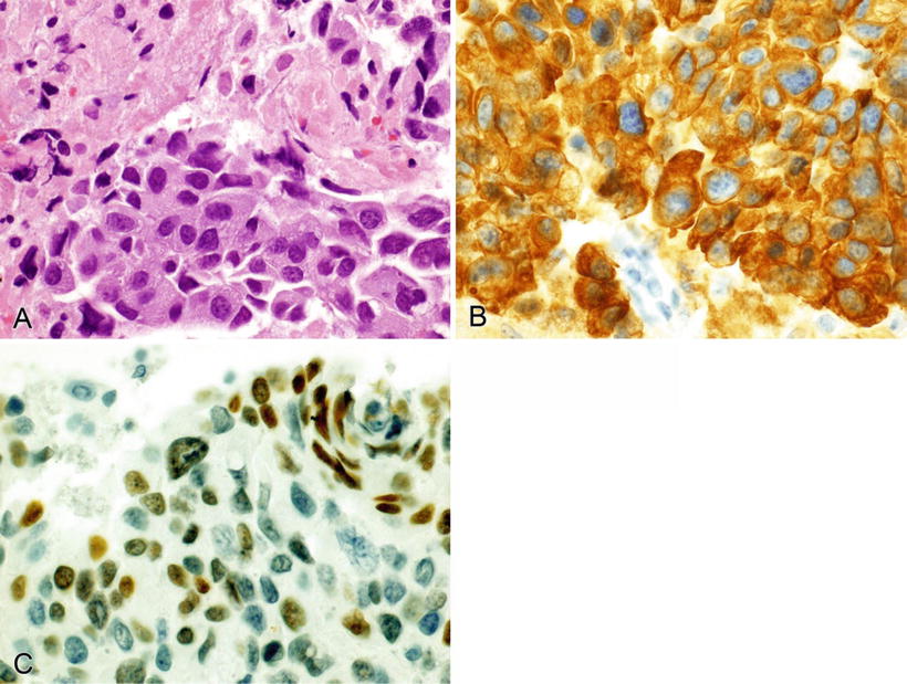 Tumors Of Unknown Primary | Basicmedical Key