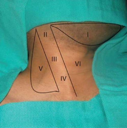 Lymph Node Dissections of the Neck | Basicmedical Key