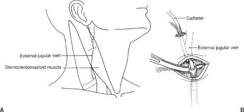 external jugular vein line placement