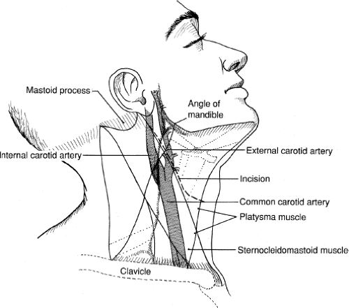 Carotid Endarterectomy | Basicmedical Key