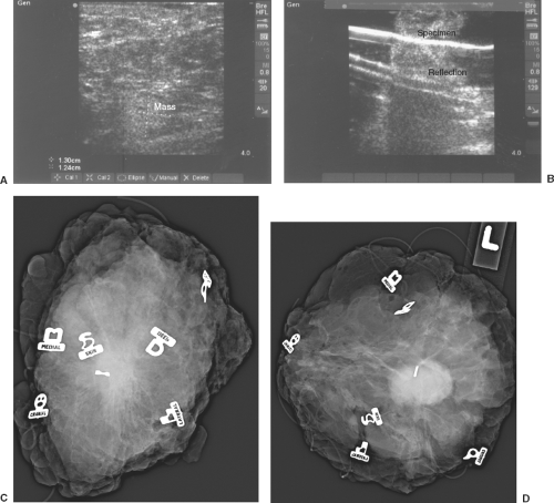 Ultrasound-Guided Breast Interventions | Basicmedical Key