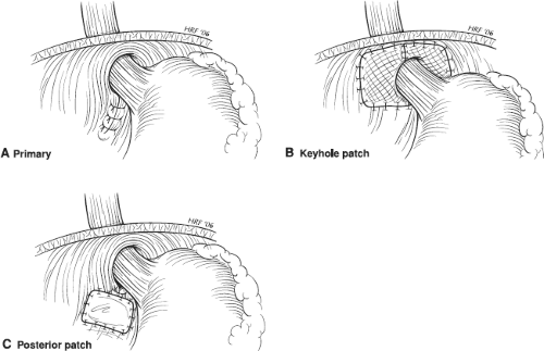 Laparoscopic Nissen Fundoplication And Hiatal Hernia Repair ...