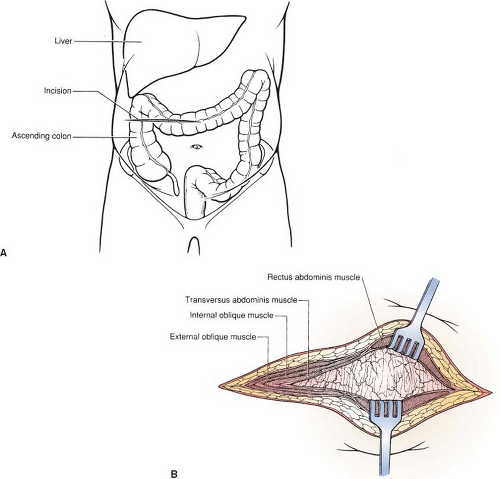 Right And Left Colon Resections Basicmedical Key