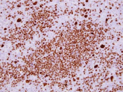 Hodgkin Lymphoma Nodular Lymphocyte Predominant Basicmedical Key 