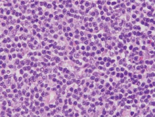 Peripheral T Cell Lymphoma Unspecified Basicmedical Key 