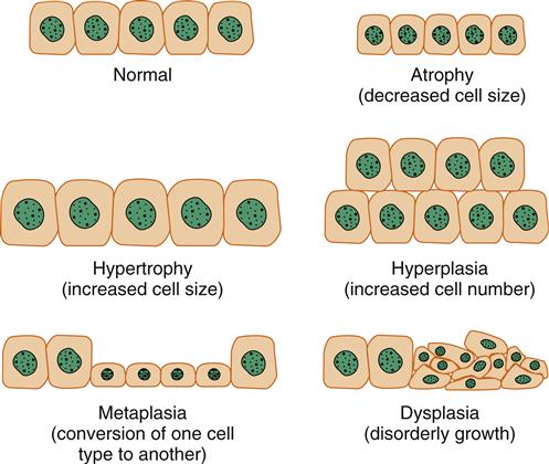 cell injury aging atrophy death hyperplasia metaplasia hypertrophy dysplasia cellular adaptive responses figure basicmedicalkey