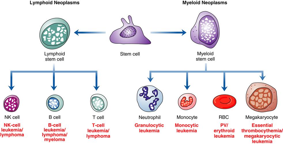 Malignant Disorders Of White Blood Cells Basicmedical Key