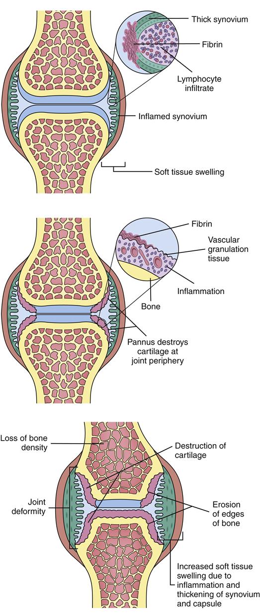 Alterations in Musculoskeletal Function: Rheumatic Disorders ...
