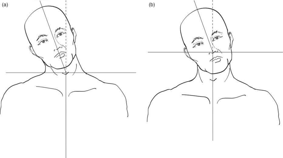 Cervical Dystonia
