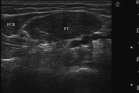 The use of botulinum neurotoxin in spasticity using ultrasound guidance ...