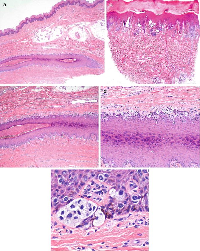 acral lentiginous melanoma histology