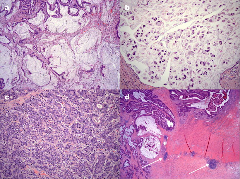 hereditary nonpolyposis colorectal cancer (hnpcc)