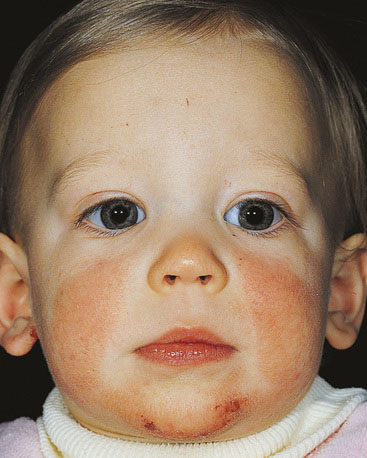 Image result for A 2-month-old infant with an erythematous maculopapular eruption covering his cheeks"