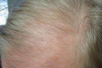 lasix side effects hair loss