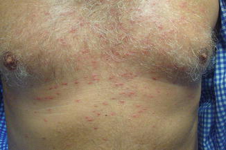 Steroid cream induced acne