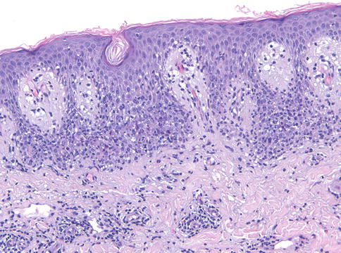 allergic contact dermatitis histology