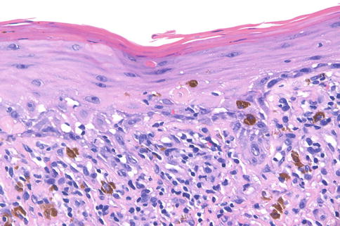 allergic contact dermatitis histology