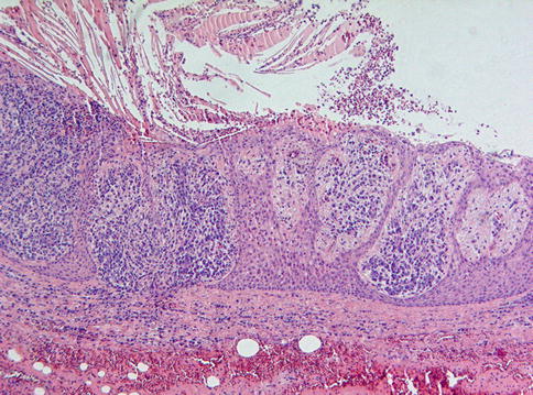 Residual Cyst Histology