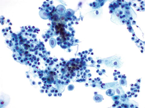 bacterial vaginosis cytology