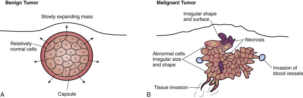 Cancer cells benign malignant - printreoale.ro - Cancer and benign tumors