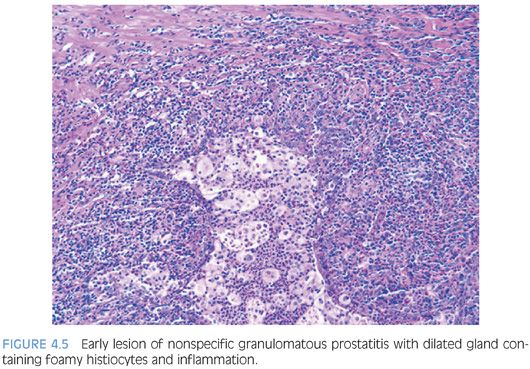 Granulomatous prosztatitis