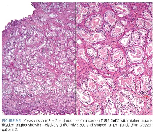 Grading of Prostatic Adenocarcinomas | Basicmedical Key