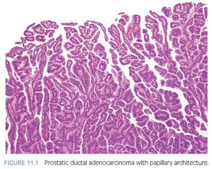 ductal adenocarcinoma prostate histology)