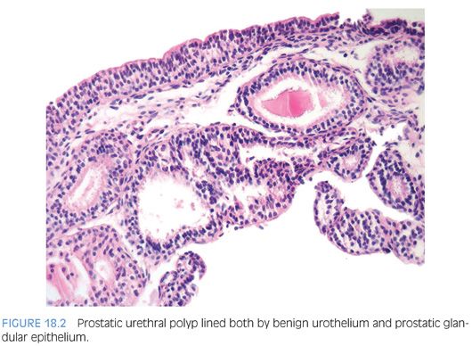 Papillary lesion prostate. Papillary lesions of urinary bladder