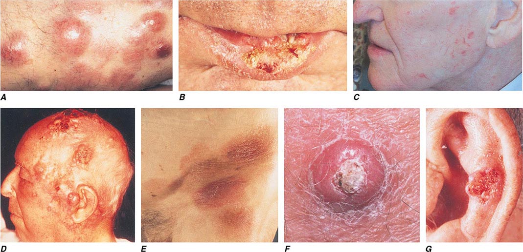 Cutaneous port-site recurrence. (A) Erythematous, indurated, hard