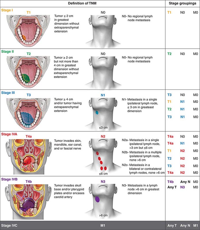 Early Stage Cancer Lymph Nodes In Neck Allthingspoliz 