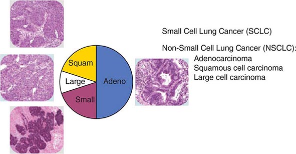 lung cancer histology