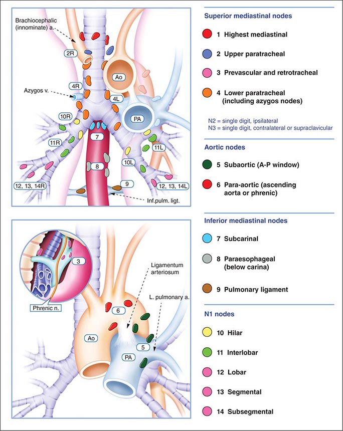 Neoplasms of the Lung Basicmedical Key