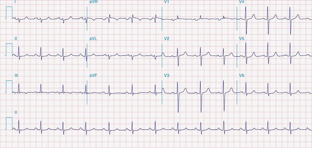 Diagnostic Cardiac Catheterization and Coronary ...