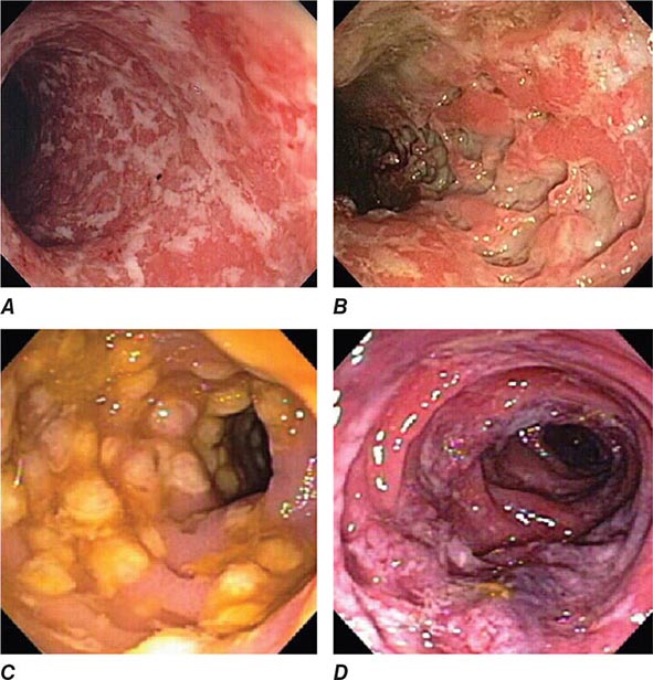 ulcerative colitis colonoscopy findings