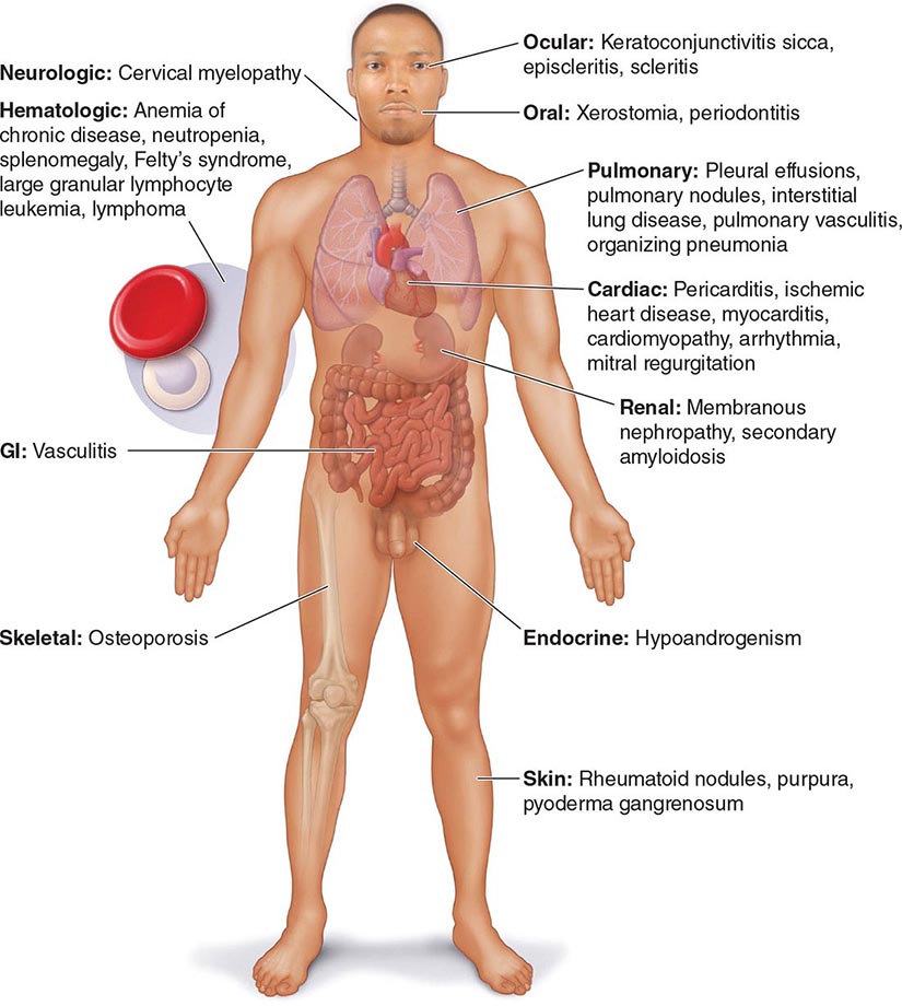 Systemic Sclerosis (Scleroderma) and Related Disorders