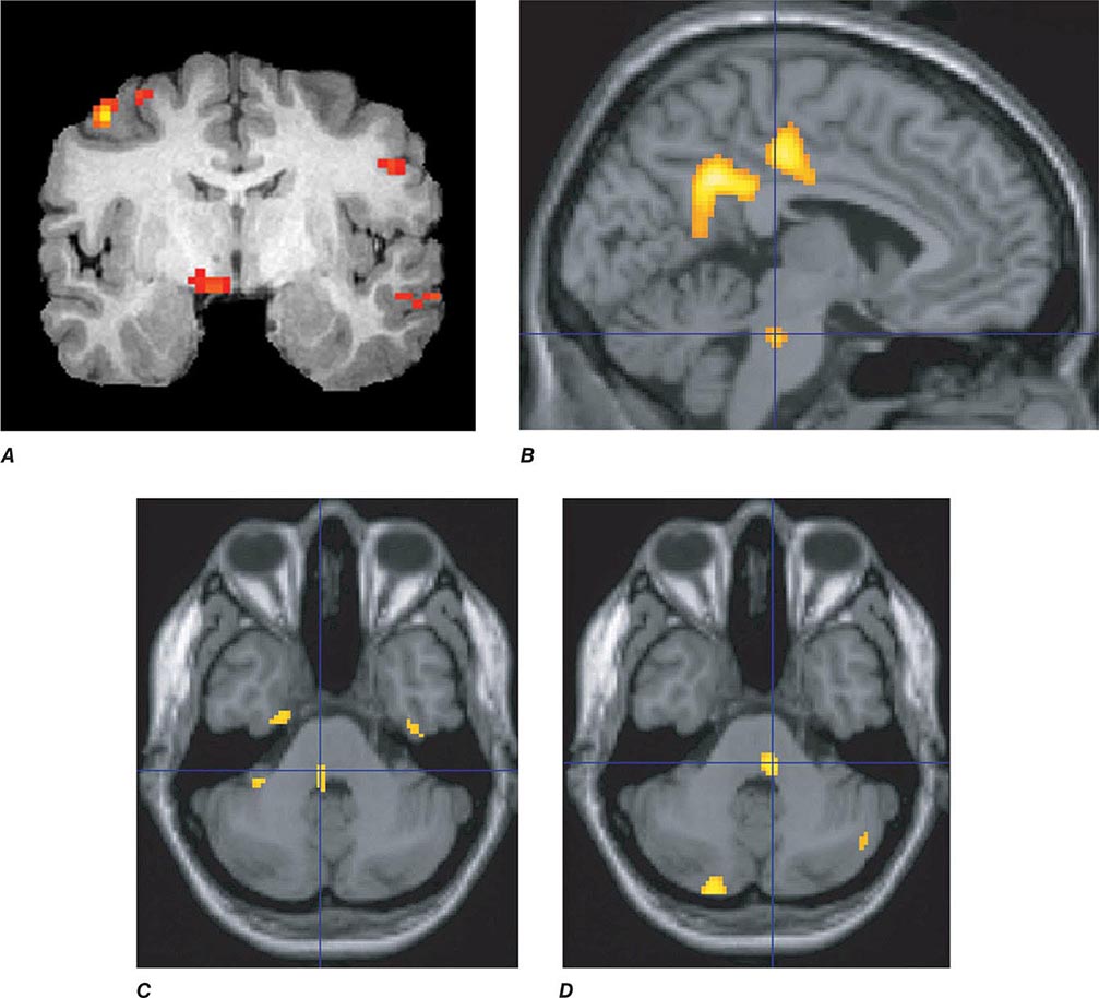 Migraine And Other Primary Headache Disorders Basicmedical Key