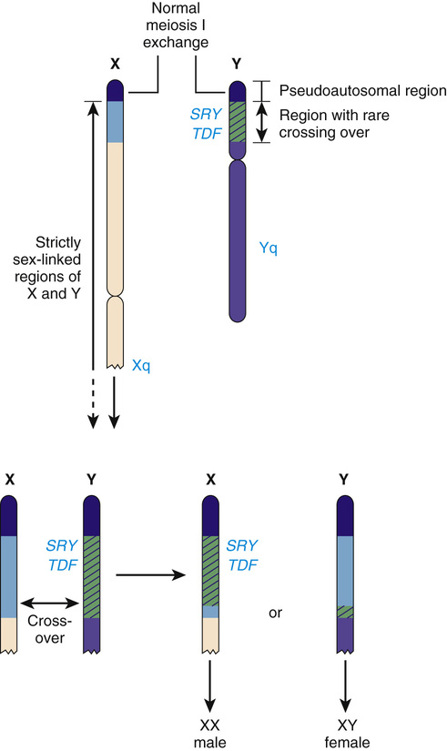 Sex Chromosomes And Their Abnormalities Basicmedical Key