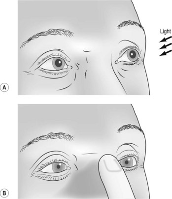 argyll robertson pupil afferent or efferent limb loss