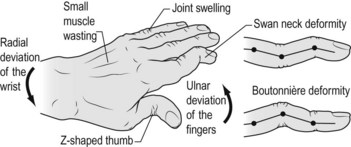 Rheumatoid hands | Basicmedical Key