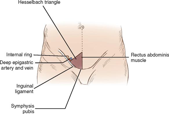 Болит паховая область у мужчин. Паховый треугольник Гессельбаха. Паховый треугольник топографическая. Паховый треугольник топографическая анатомия. Паховый промежуток анатомия.