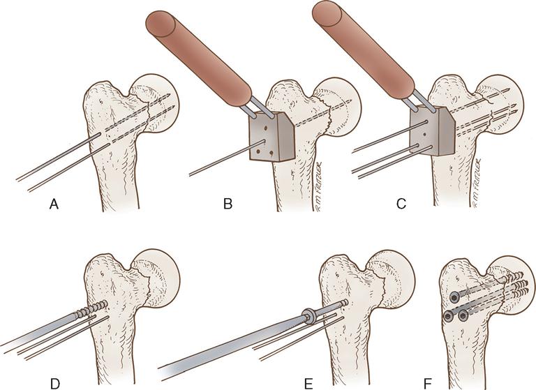 11. Orthopedic Surgery | Basicmedical Key