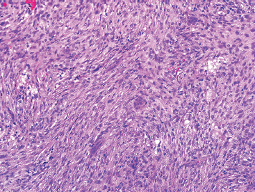 spindle cell tumor
