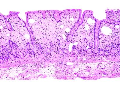 Nonneoplastic Intestinal Diseases | Basicmedical Key