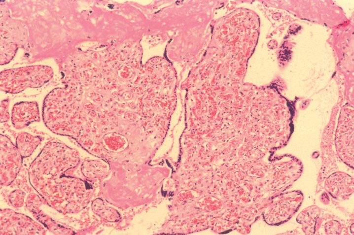 Neoplasia Basicmedical Key