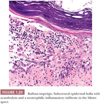 bullous impetigo histology