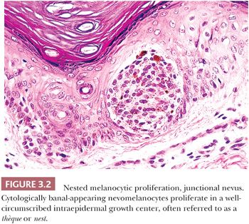 junctional nevus foot