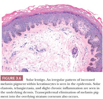 Melanocytic Lesions Basicmedical Key Melanocytic Lesions Basicmedical Key