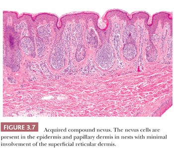 Melanocytic Lesions | Basicmedical Key