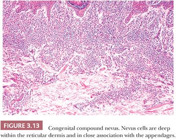 congenital melanocytic nevus histology