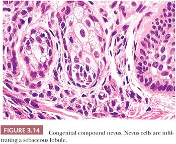 congenital melanocytic nevus histology